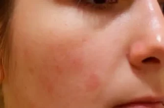 Чому з’являються плями на обличчі?